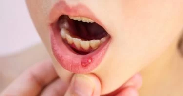أعراض مرض بهجت عند الأطفال 